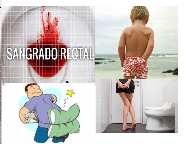 hemorroides internas sintomas heces acintadas